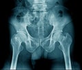 X-ray pelvic bone