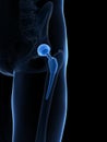 Hip replacement