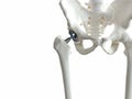 A hip replacement Royalty Free Stock Photo