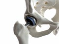 A hip replacement Royalty Free Stock Photo