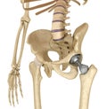 Hip replacement implant installed in the pelvis bone. Royalty Free Stock Photo