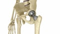 Hip replacement implant installed in the pelvis bone. Medically accurate