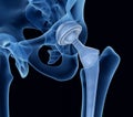 Hip replacement implant installed in the pelvis bone. X-ray view.