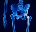 Hip replacement implant installed in the pelvis bone. X-ray view. Medically accurate illustration