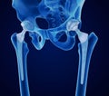 Hip replacement implant installed in the pelvis bone. X-ray view. Medically accurate illustration