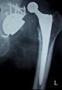 Hip replacement implant Xray scan Royalty Free Stock Photo