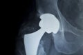 Hip replacement implant Xray scan Royalty Free Stock Photo