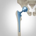 Hip Replacement Surgery Royalty Free Stock Photo