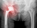 Hip replacement x-ray, 8 weeks after surgery Royalty Free Stock Photo