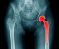 Hip replacement x-ray Royalty Free Stock Photo