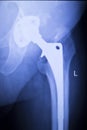 Hip replacement xray orthopedic medical scan Royalty Free Stock Photo