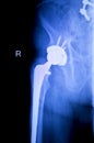 Hip replacement xray orthopedic medical scan Royalty Free Stock Photo