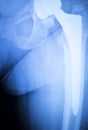 Hip titanium implant replacement xray Royalty Free Stock Photo