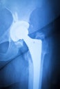 Hip titanium implant replacement xray Royalty Free Stock Photo