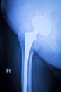 Hip titanium implant replacement xray Royalty Free Stock Photo