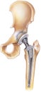 Hip - Total Replacement Royalty Free Stock Photo