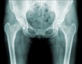 Hip x-ray, hip pain