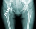 Hip x-ray, with repair of a fracture screws