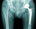 Hip x-ray with replacement of the joint