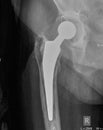 Hip x-ray with replacement of the joint,4 years after surgery