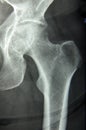 Hip xray, classic radiography Royalty Free Stock Photo