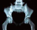 Hip Xray - front view Royalty Free Stock Photo