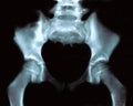 Hip Xray - front view