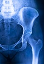 Hips pelvis xray scan