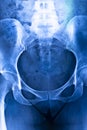 Hips pelvis xray scan