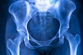 Hips pelvis xray scan