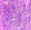 A histological slide of a tissue sample. Large cell lymphoma in the colonic mucosa