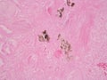 Histology of abnormal tissue (calcium) Royalty Free Stock Photo