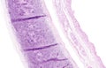 Histology of human tissue, show tracheitis and squamous metaplasia of bronchial mucosa as seen under the microscope