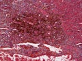 Histology of possible Melanoma