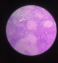 Histology slide  of lymphadenitis Royalty Free Stock Photo