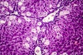 Histopathology of acute hepatitis Royalty Free Stock Photo