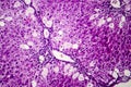 Histopathology of acute hepatitis Royalty Free Stock Photo