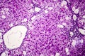 Histopathology of acute hepatitis Royalty Free Stock Photo