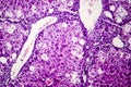 Histopathology of acute hepatitis