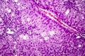 Histopathology of acute hepatitis Royalty Free Stock Photo