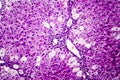 Histopathology of acute hepatitis Royalty Free Stock Photo