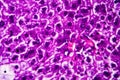 Histopathology of acute hepatitis Royalty Free Stock Photo