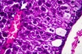 Histopathology of acute hepatitis