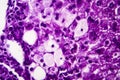 Histopathology of acute hepatitis Royalty Free Stock Photo