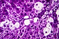 Histopathology of acute hepatitis