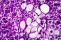 Histopathology of acute hepatitis Royalty Free Stock Photo