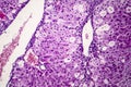 Histopathology of acute hepatitis Royalty Free Stock Photo
