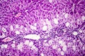 Histopathology of acute hepatitis Royalty Free Stock Photo