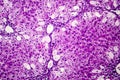 Histopathology of acute hepatitis Royalty Free Stock Photo