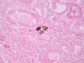 Histopathology of Calcium Deposits in Human Kidney Royalty Free Stock Photo
